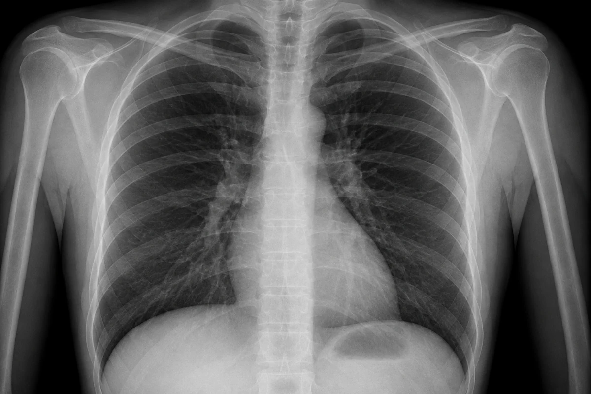 CR · CHEST PA · DICOM